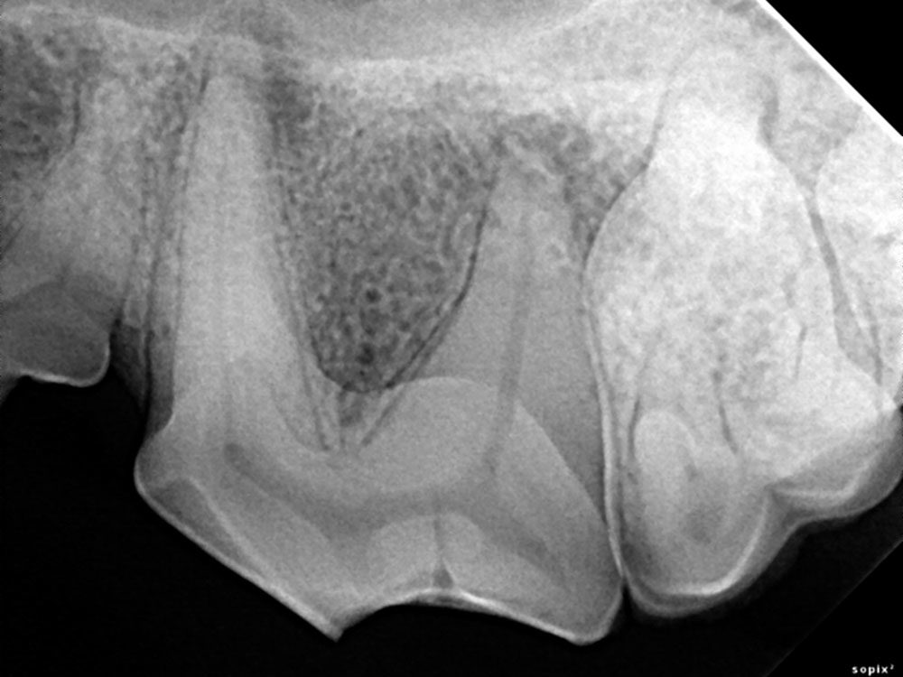 This radiograph shows a tooth that was fractured long before this radiograph was taken. As dogs and cats mature, their pulp chamber becomes narrower. When pulp necrosis occurs, this process stops. This radiograph shows that this tooth is non-vital because its pulp chamber is much wider than the teeth on either side of it. Also note the decrease in bone density at the root apices (tips), indicating periapical abscess, or extension of the pulp decay into the periodontal tissue.