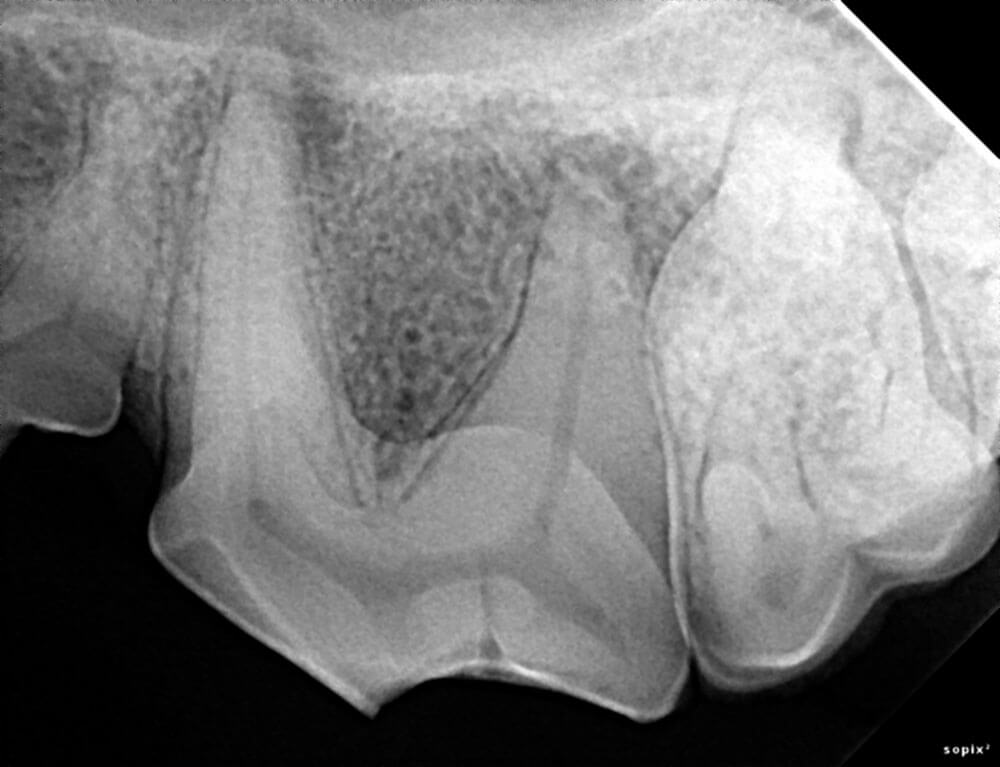 This radiograph shows a tooth that was fractured long before this radiograph was taken. As dogs and cats mature, their pulp chamber becomes narrower. When pulp necrosis occurs, this process stops. This radiograph shows that this tooth is non-vital because its pulp chamber is much wider than the teeth on either side of it. Also note the decrease in bone density at the root apices (tips), indicating periapical abscess, or extension of the pulp decay into the periodontal tissue.