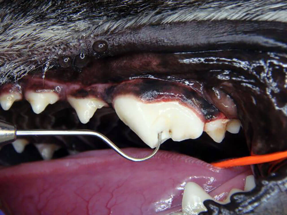 tooth-fracture-exposed-by-cleaning-and-exploration tooth-fracture-exposed-by-cleaning-and-exploration