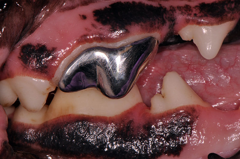 Metal Crown Clinical